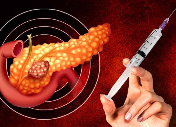 অগ্ন্যাশয়ের ক্যানসার চিকিৎসায় নতুন আশার আলো: এমআরএনএ প্রযুক্তিতে তৈরি টিকার সাফল্য
