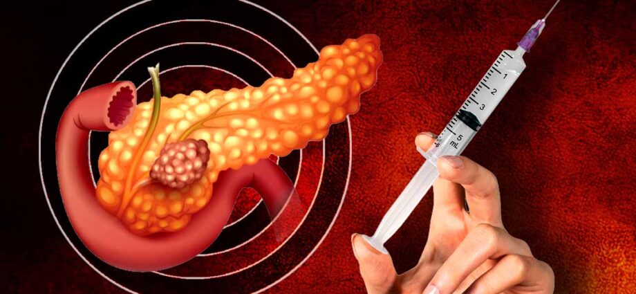 অগ্ন্যাশয়ের ক্যানসার চিকিৎসায় নতুন আশার আলো: এমআরএনএ প্রযুক্তিতে তৈরি টিকার সাফল্য